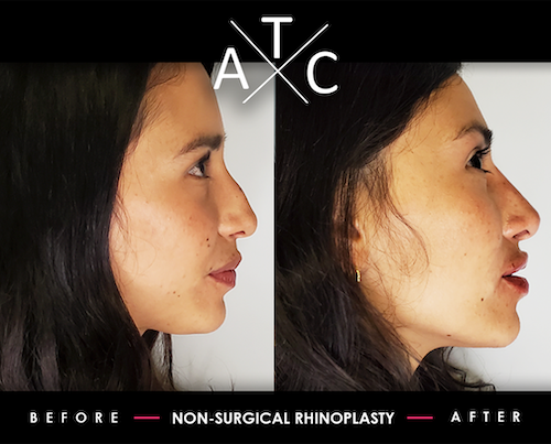 Non-Surgical Rhinoplasty Training Results 2